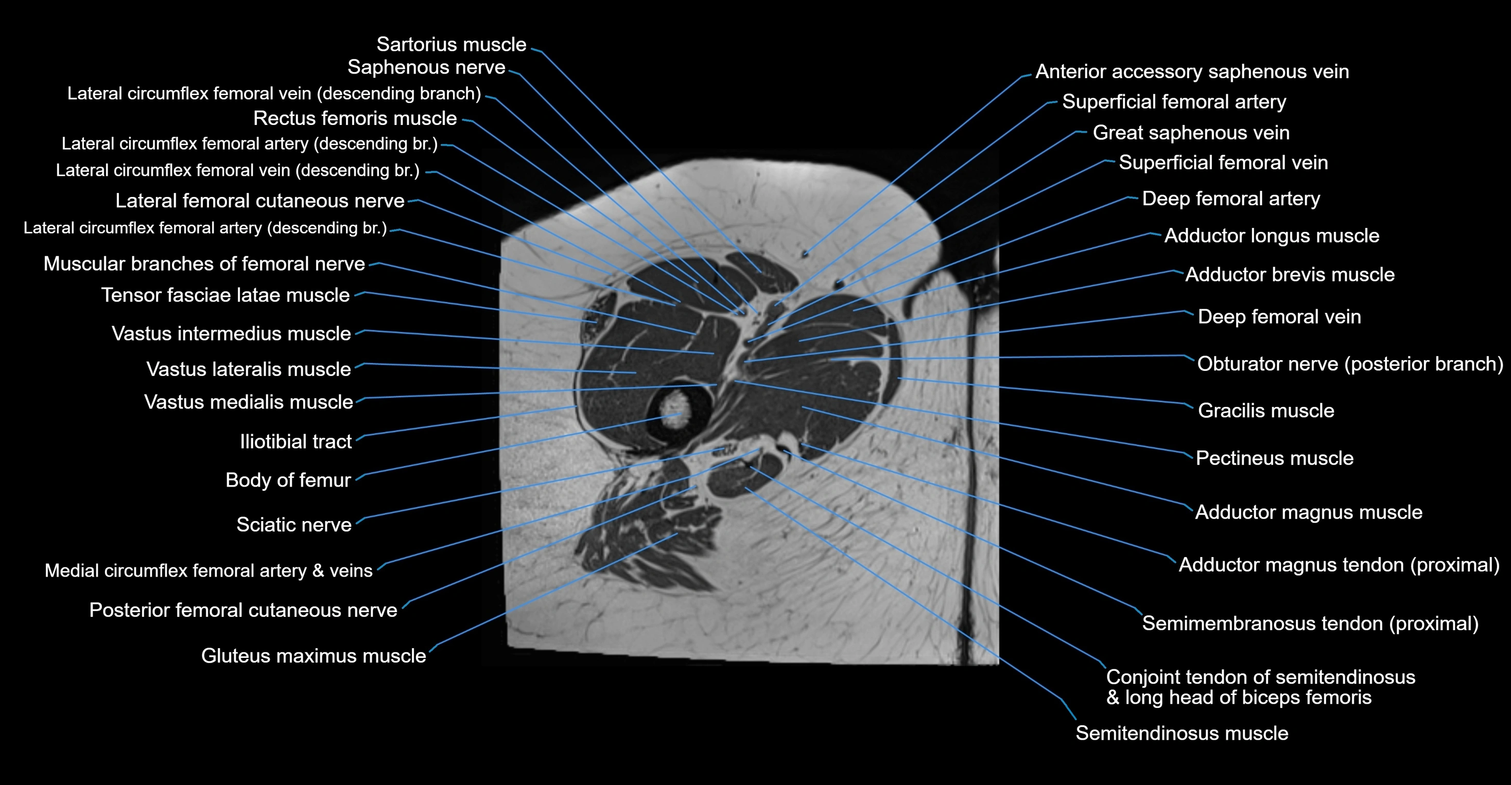 MRI hip axial cross sectional anatomy 3T 3D  radiology  anatomy image-img-00001-00087.webp